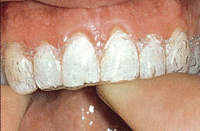 ホワイトニング前の歯のクリーニング