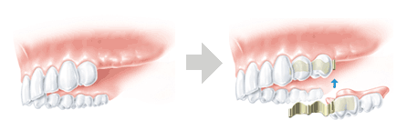 部分入れ歯の治療法